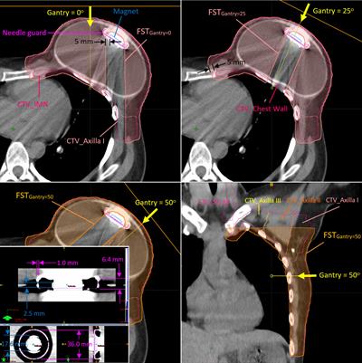 Case Report: Cumulative proton dose reconstruction using CBCT-based synthetic CT for interfraction metallic port variability in breast tissue expanders